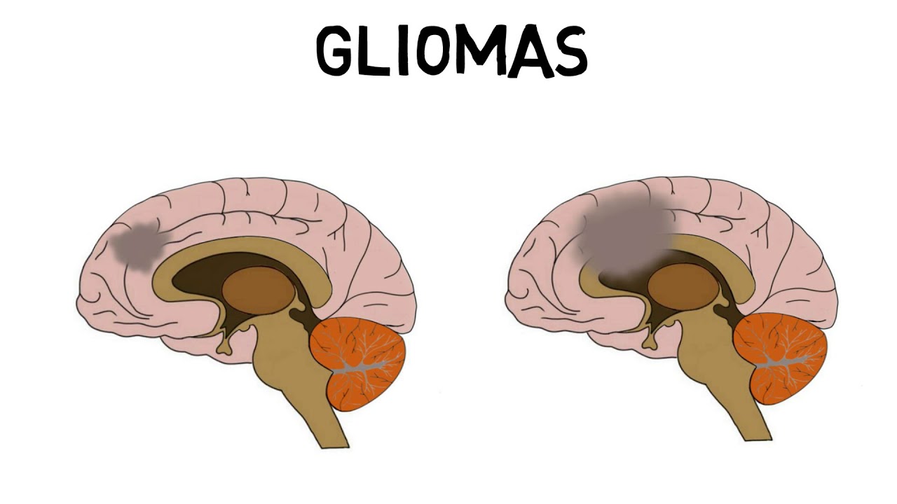 An In-Depth Guide To Gliomas: Everything You Need To Know.