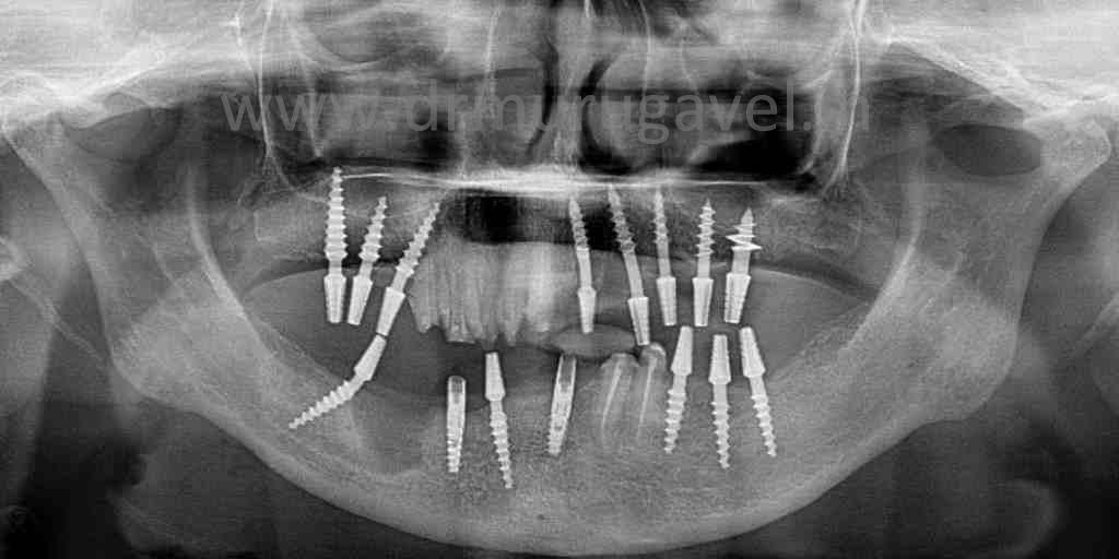 Failed Tooth Supported Bridge Replaced In Upper And Lower Jaw With Single Piece Implant