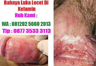 Muncul luka lecet pada kemaluan pria | lecet dan mengoreng