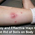 How To Get Rid of Boils on Inner Thigh | Effective Home Remedies to Get Rid of Boils