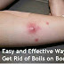 How To Get Rid of Boils on Inner Thigh | Effective Home Remedies to Get Rid of Boils