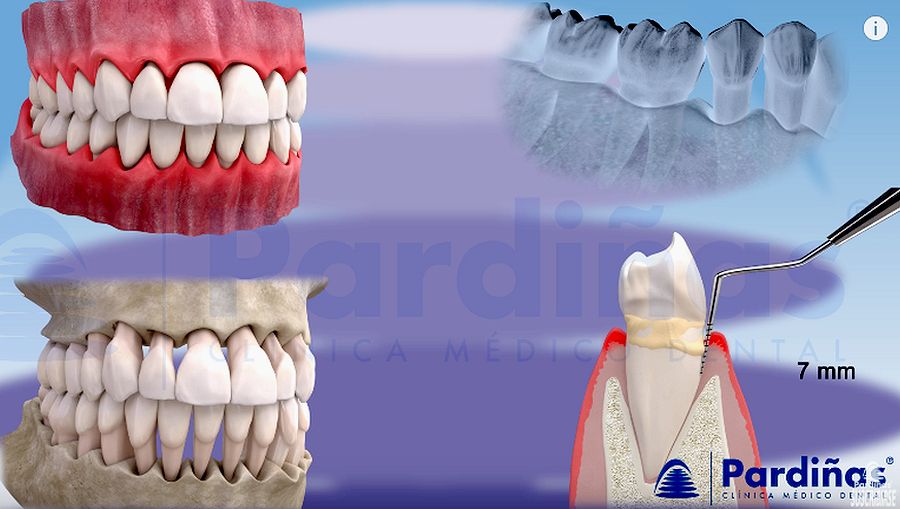 PERIODONTICS Evolution of Gingivitis and Periodontitis Clínica Pardiñas