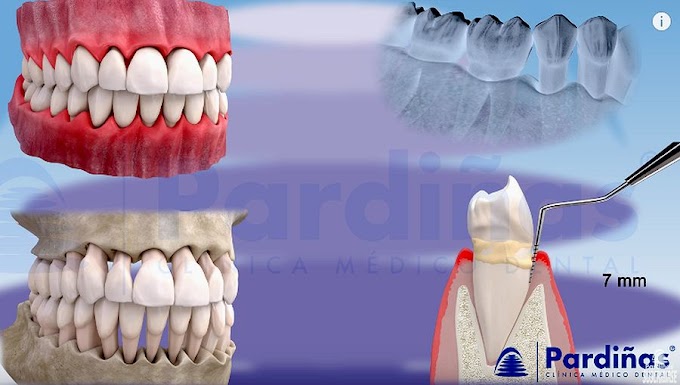 PERIODONTICS: Evolution of Gingivitis and Periodontitis - Clínica Pardiñas