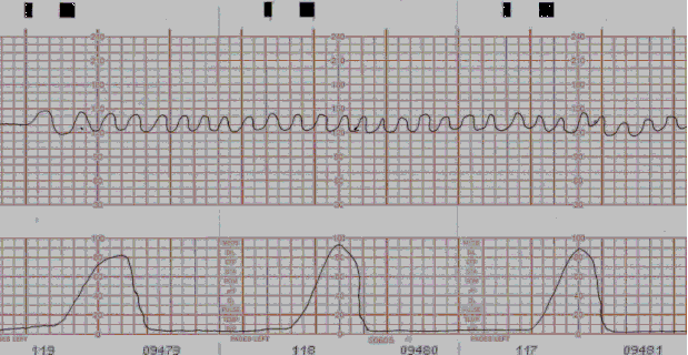 ObGyne Short Notes: What is the sinusoidal pattern (CTG)?