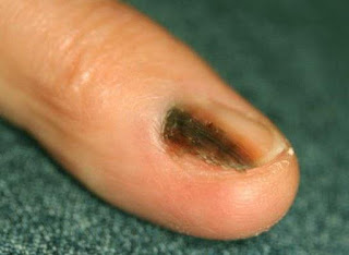 Melanoma of nail)