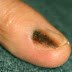 Μελάνωμα σε νύχι, άκρες δακτύλων. Οι σκούρες γραμμές στα νύχια είναι αιμάτωμα ή καρκίνος; 