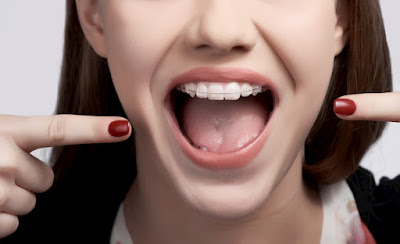 Có nên niềng răng bị móm không?