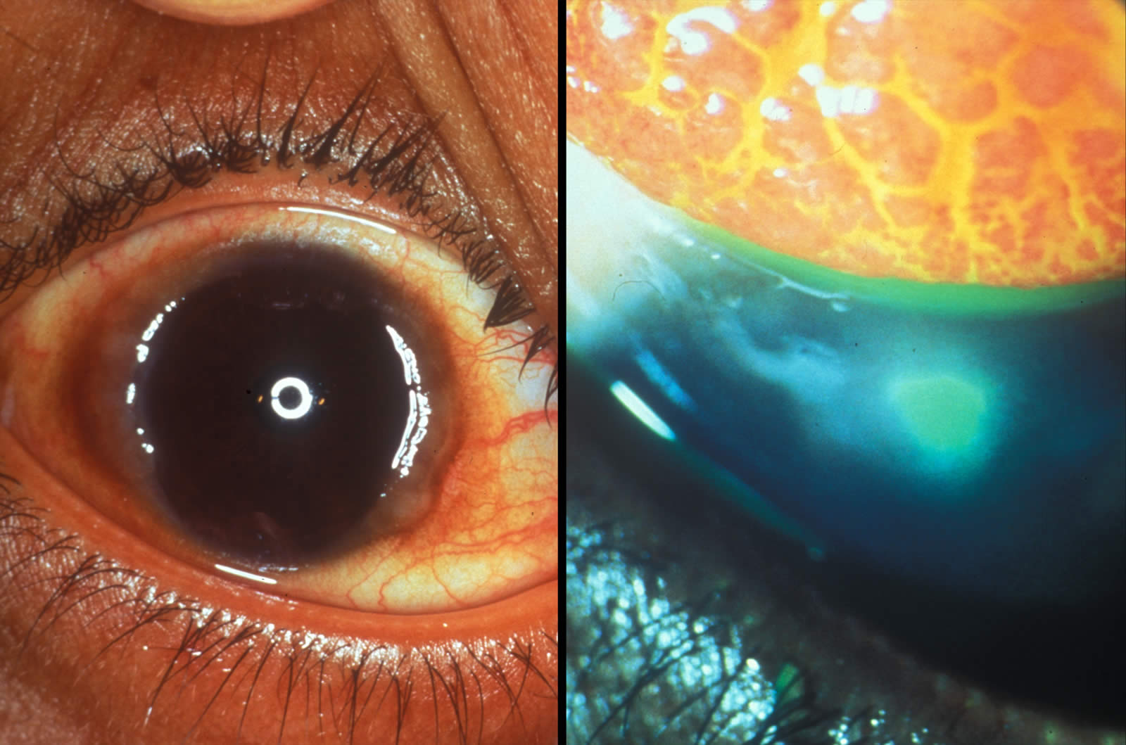 VERNAL KERATOCONJUNCTIVITIS (VKC) OR SPRING CATARRH