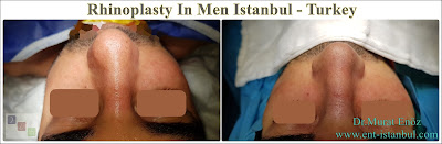 Rhinoplasty In Men,Rhinoplasty In Istanbul,Rhinoplasty In Turkey, Nose Job For Male, Male Nose Job in Turkey