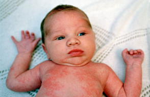 Rawatan Tradisional Atasi Ruam Bayi Dan Jenis Ruam Pada Bayi  Cikgu Ennie