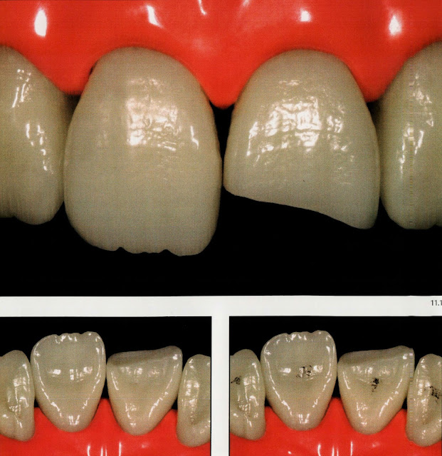Class IV composite " silicone guide technique " Dental Esthetics