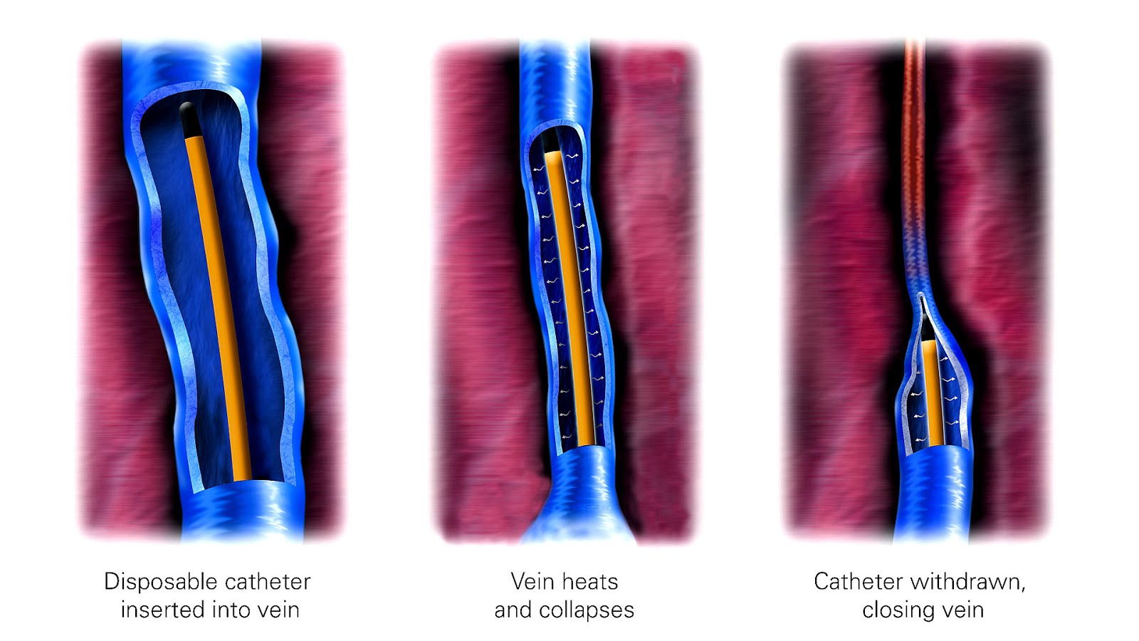 Vein Ablation Side Effects Effect Choices