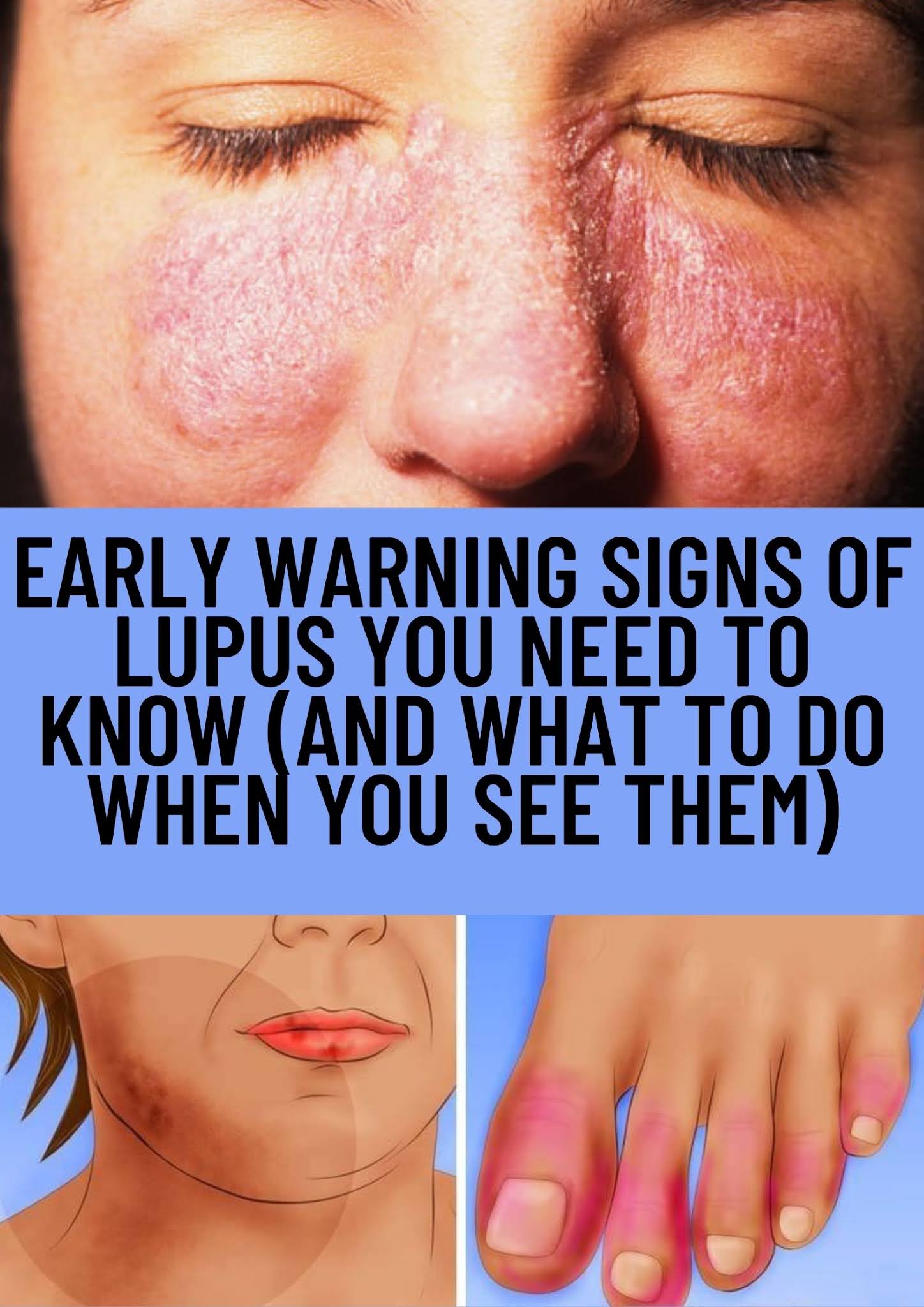 Early Warning Signs of Lupus You Need to Know (And What to Do When You
