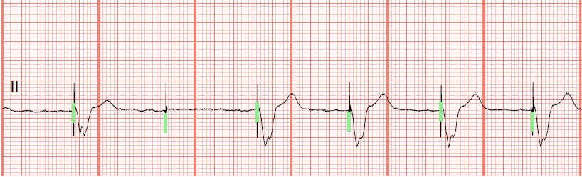 ventricular paced failure to capture ventricular paced failure to capture