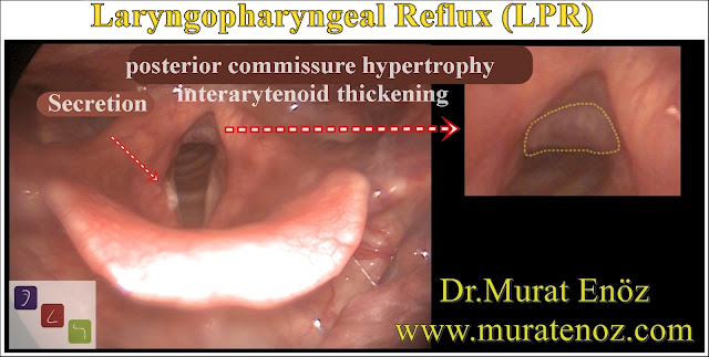 Laryngopharyngeal Reflux (LPR)