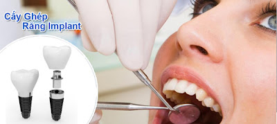 Trồng răng cố định trong trường hợp mất răng
