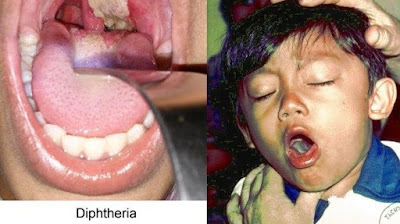 cara mengatasi difteri pada anak