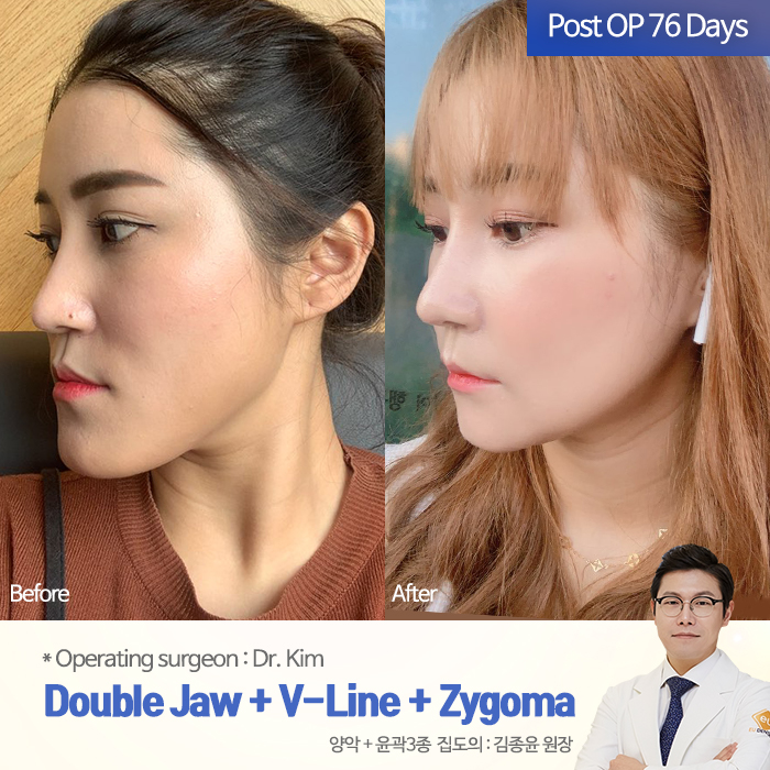 How to improve lantern jaw through double jaw surgery.