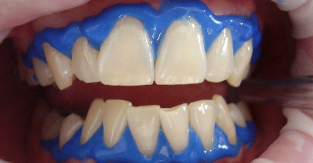 Bleaching Gigi Bandung