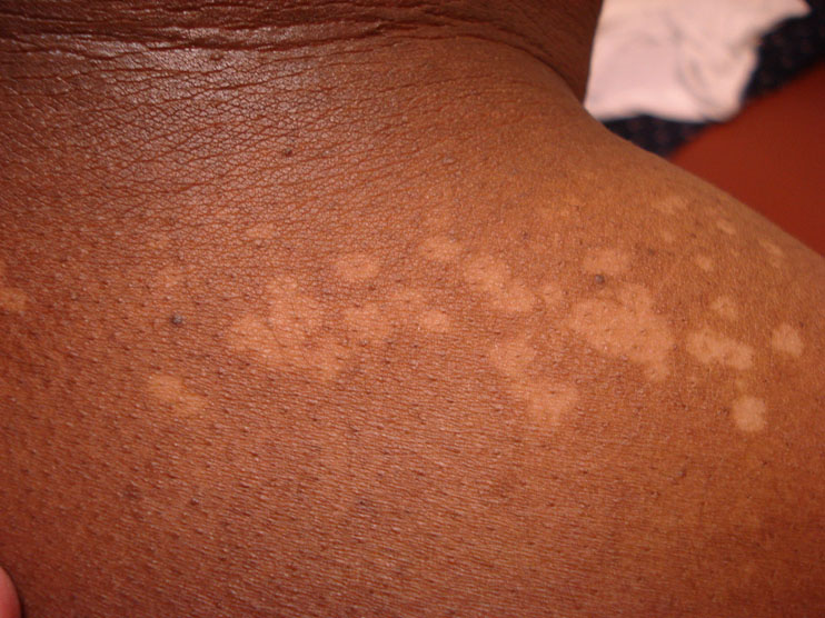 virtual-grand-rounds-in-dermatology-2-0-hypopigmentation-in-an-african