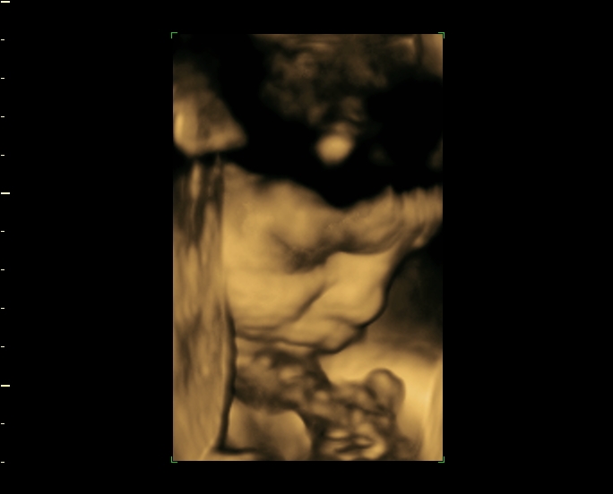 Cochinblogs Some 3d And 4d Ultrasound Images Of 3rd Trimester