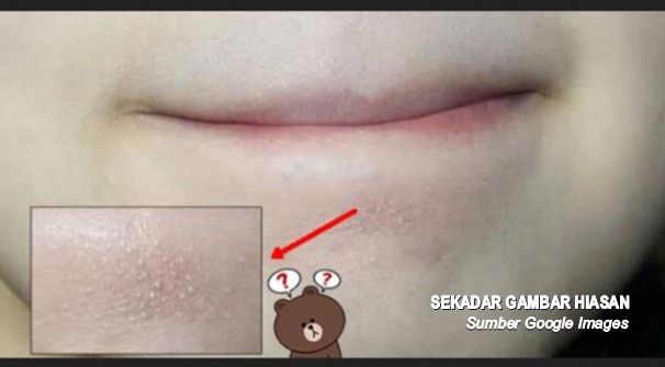 Perempuan Wajib Baca Tahukah Anda Bintik Bintik Putih Yang Sering Muncul Di Wajah Anda Itu Apa