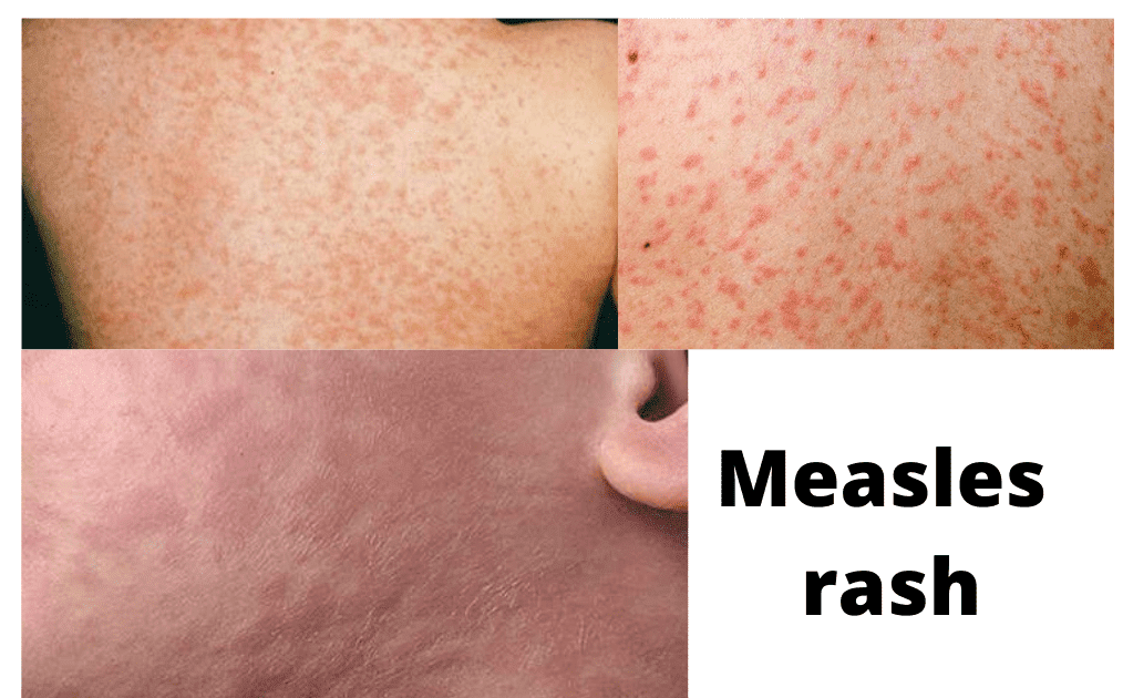 Measles (Rubeola) Symptoms, Causes, Diagnosis and Treatment