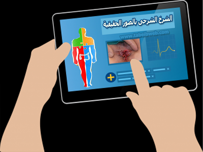تعرف على الشرخ الشرجى بالصور الحقيقية طبيب ويب