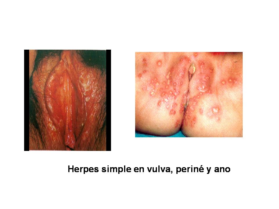 Common Symptoms of Genital Herpes in Men and Women