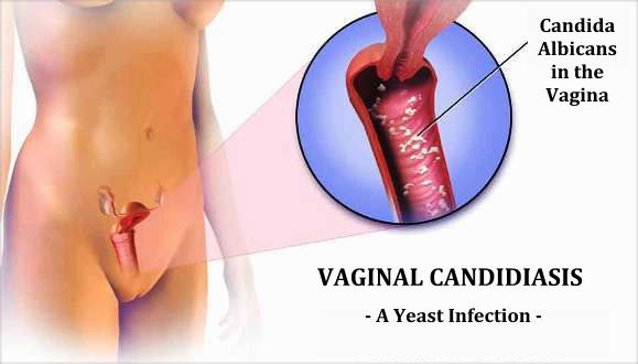 Como curar la candidiasis vaginal