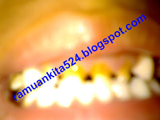  Sakit gigi ialah rasa sakit di sekitar gigi atau rahang terutama sebagai akhir dari kon Cara Alami Mengobati Sakit Gigi