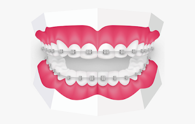 Best Orthodontist Melbourne