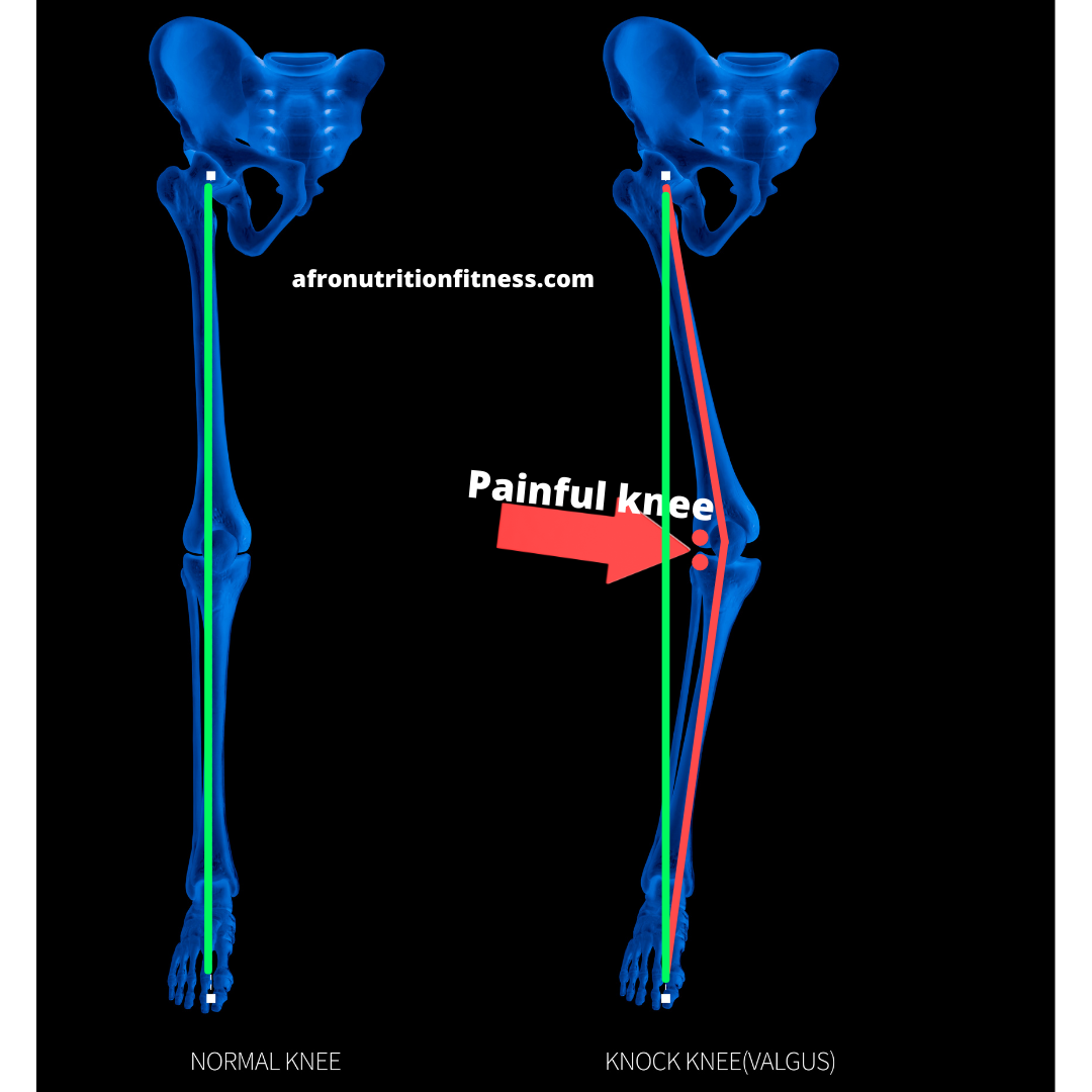Knee Pain While Running? Here’s 5 Keys To Treat Knee Pain After Running