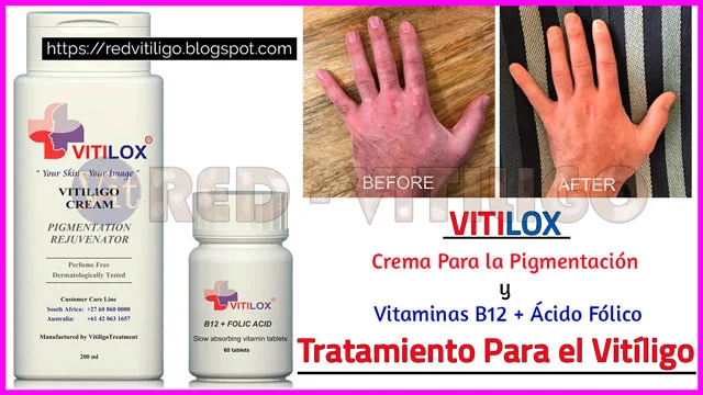 Vitilox Tratamiento Para Vitiligo