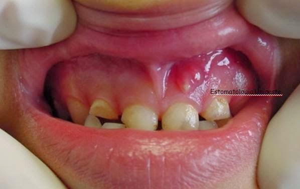 Sobre a Saúde Bucal.: Cistos Odontogênicos