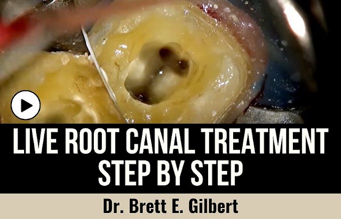 Live ROOT CANAL TREATMENT on tooth #18 Step by Step - Dr. Brett E. Gilbert