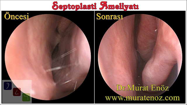 Septoplasti Ameliyatı İle İlgili Sık Sorulan Sorular