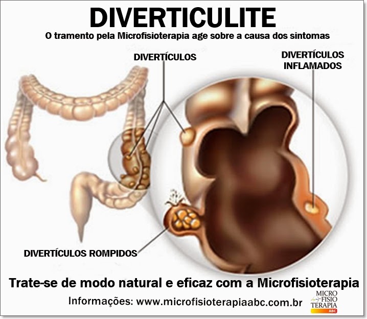 Microfisioterapia ABC DIVERTICULITE Microfisioterapia ABC DIVERTICULITE