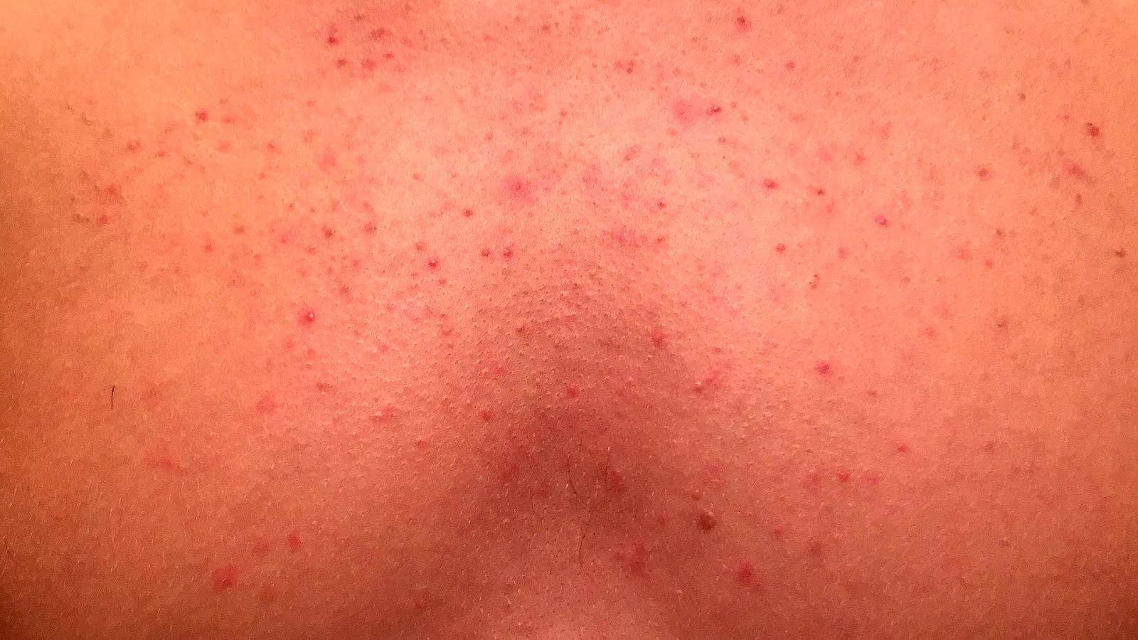 How To Get Rid Of Acne On Chest And Back How Choices