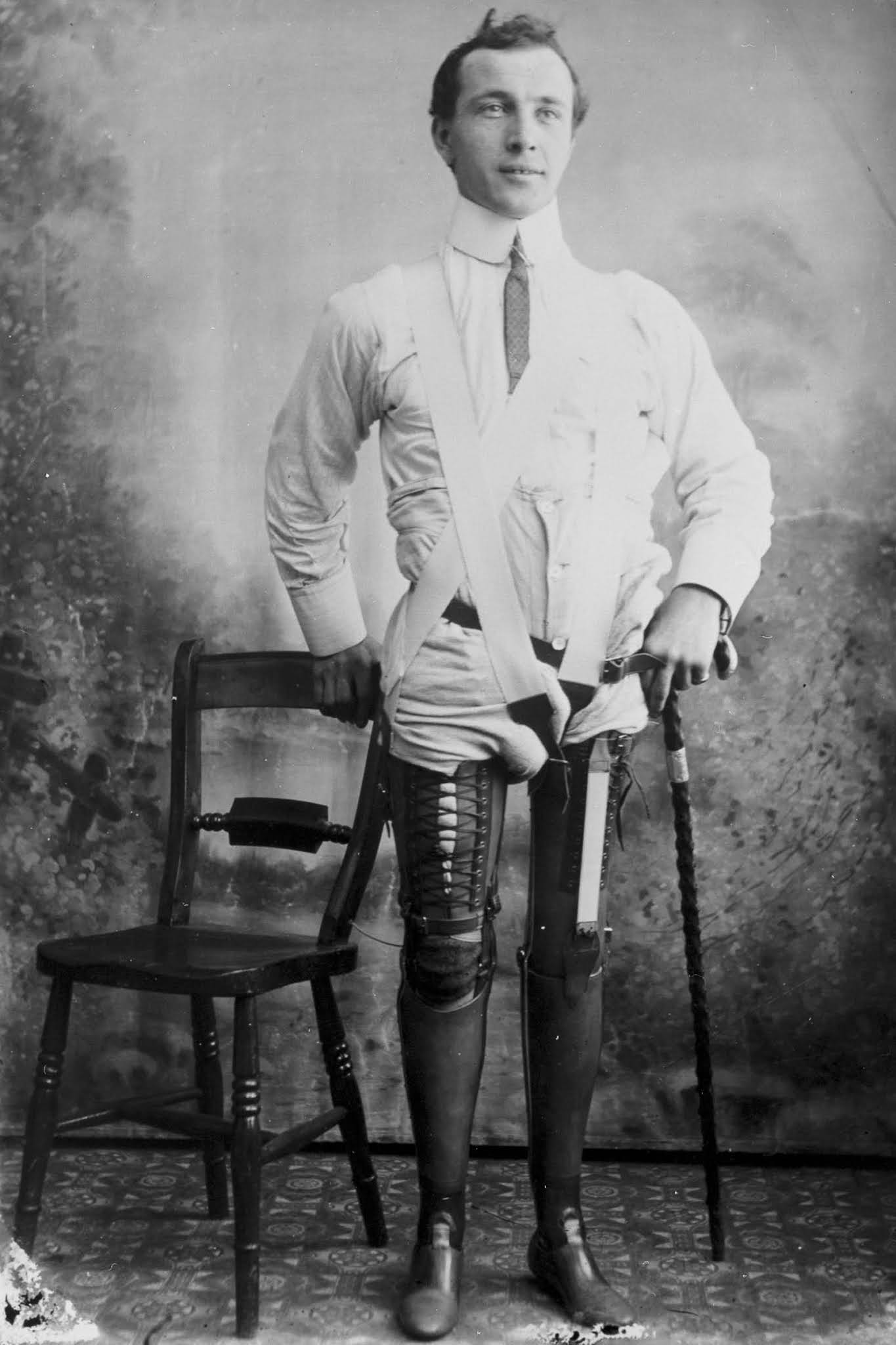 The extraordinary early prostheses made by James Gillingham  1900 - 13