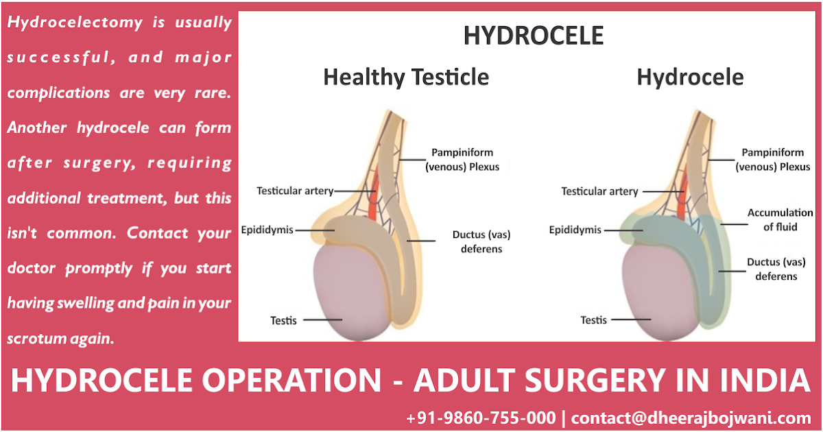 Hydrocele Surgery in India What You Need to Know