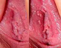 Cara Ampuh mengobati daging tumbuh di bibir vagina/Kutil kelamin