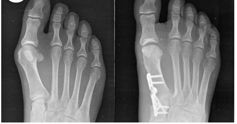 A Boomer Girl’s Guide - Embracing MY 70’s: My experience with bunion