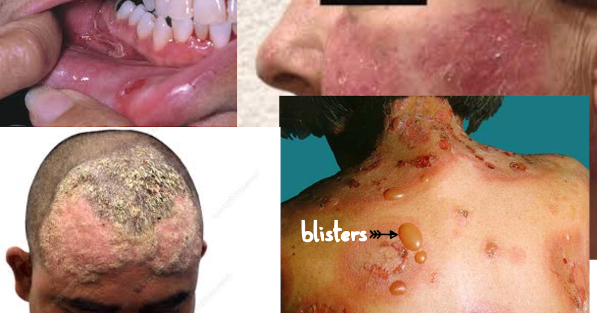 YES AN AUTOIMMUNE DERMAT DISORDER PEMPHIGUS: MANAGE BY HOMEOPATHY AND