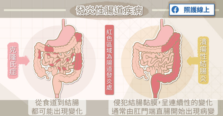 潰瘍性結腸炎與克隆氏症有什麼差異？