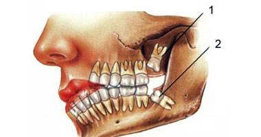 كيف نتجنب أضرار خلع ضرس العقل كيف نتجنب أضرار خلع ضرس العقل