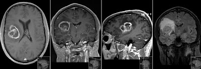 glioblastoma mri radiology multiforme right frontal tumor gbm grade iv imaging