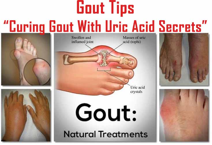 Easy Gout Treatment and Prevention Tips: Gout Tips - Curing Gout With