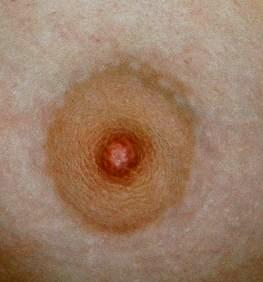 Black Dots On Nipples 115