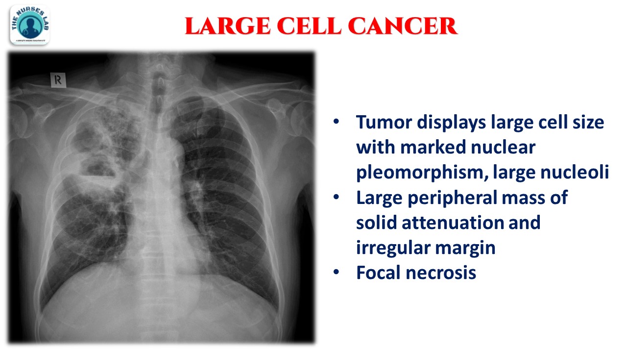Abnormal Chest Xray Interpretation